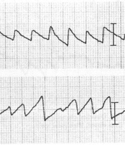 nystagmogram